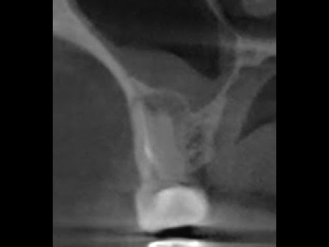Одонтогенный гайморит на компьютерной томографии. Удаление "кисты" зуба. Периодонтит. Гранулема зуба
