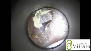 耳掃除動画vol.９「皮のように取れる耳垢」