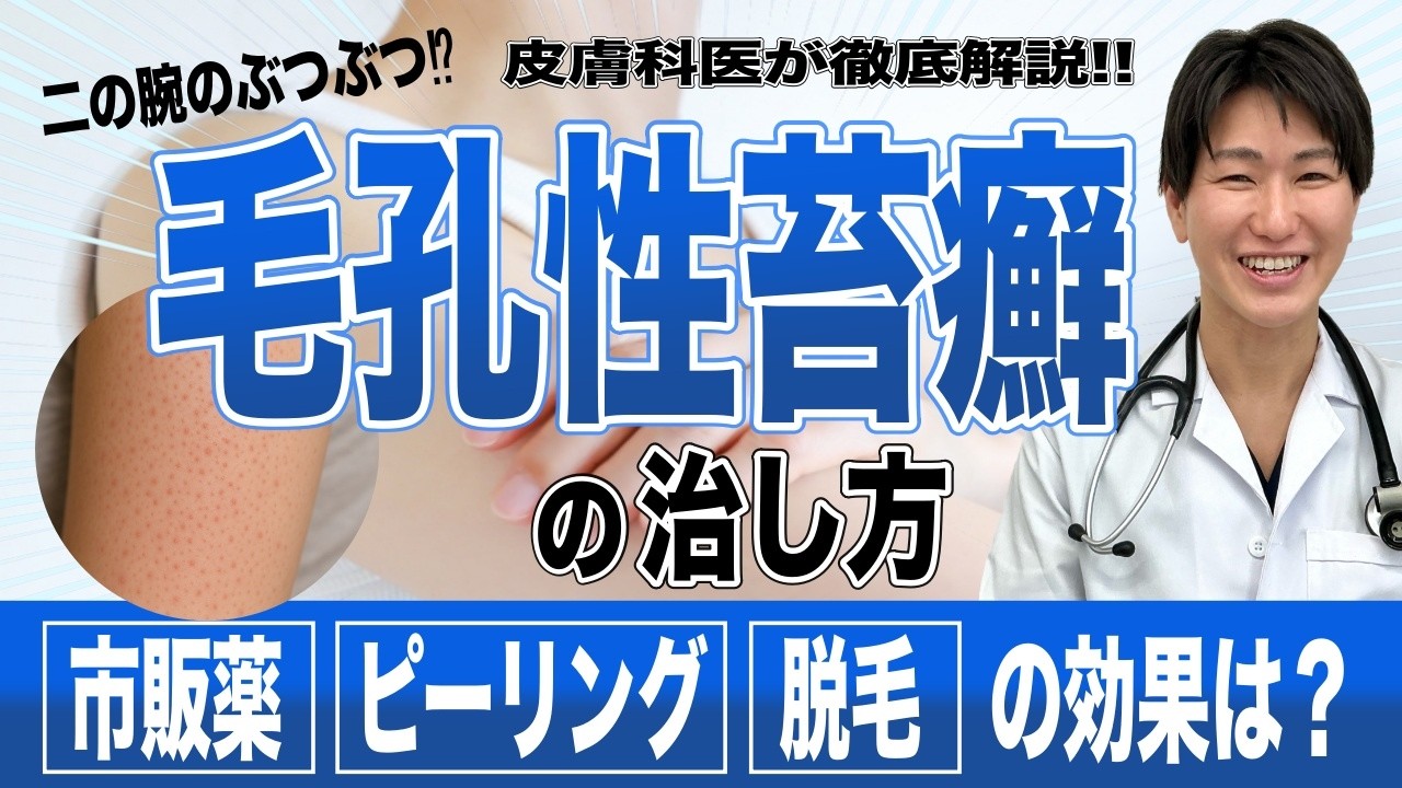 毛孔性苔癬（もうこうせいたいせん）について医師が解説