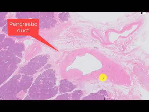 A discussion of 4 pancreatic cystic lesions