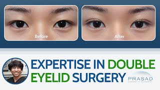 Expertise in Asian Double Eyelid Surgery