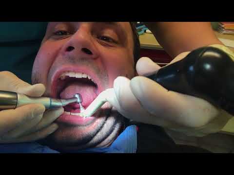 Professionelle Zahnreinigung (PZR) Zahnstein Entfernung, Scaling, airflow, Politur, Fluoridierung