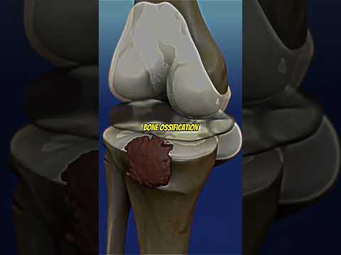 Open Growth Plates vs Closed Open Plates (Bone ossification) #health #taller #bones