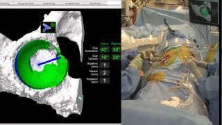 Robotically Guided Primary Hip Replacement– 06/20/2014