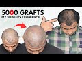Fue Hair Transplant | Best Cost & Results of Fue Hair Transplant