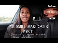 MY SMILE MAKEOVER & JOURNEY (PART 1)🤯😁 | ONYI OKEKE