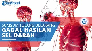 Anemia Aplastik, Jenis Kelainan Darah Disebabkan Kegagalan Sumsum Tulang Menghasilkan Sel Darah