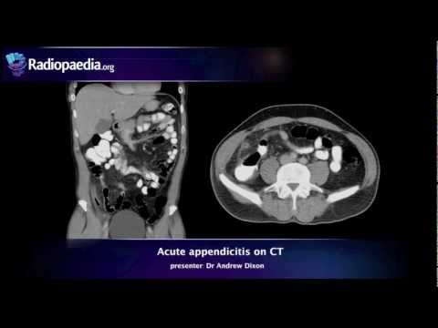 Acute appendicitis on CT - radiology video tutorial
