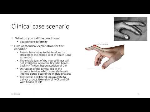 EXTENSOR EXPANSION OF HAND AND FOOT by Prof. Dr. V. Subhadra Devi