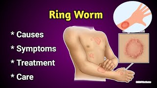 Ring Worm Causes, symptoms and Treatment
