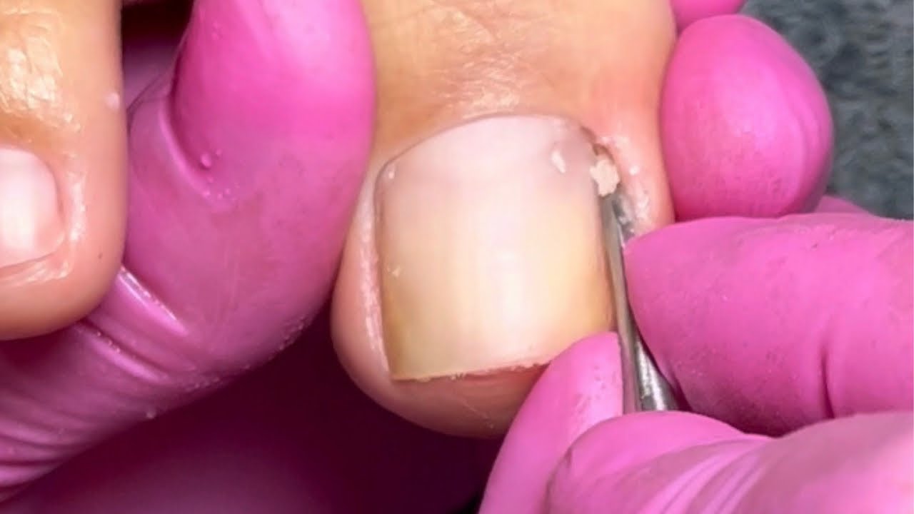 "Truques Incríveis para Eliminar a Pele Incômoda sob a Unha do Dedão do Pé!"