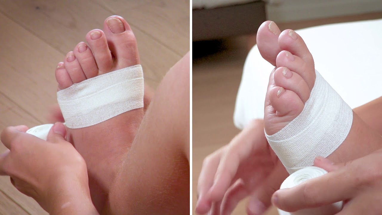Auto-bandage des orteils avec un lymphœdème primaire