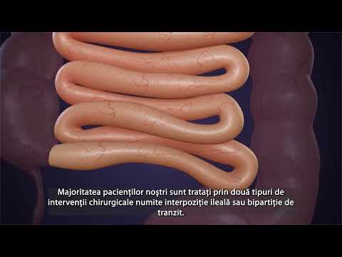 Ce este chirurgia metabolică?