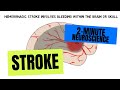 2 Minute Neuroscience Stroke