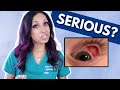 Blood In The Eye Eye Doctor Explains