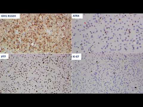 AANP Teaching Rounds - January 25, 2021 - Neoplastic Disease: Diagnostic Approach to Diffuse Glioma
