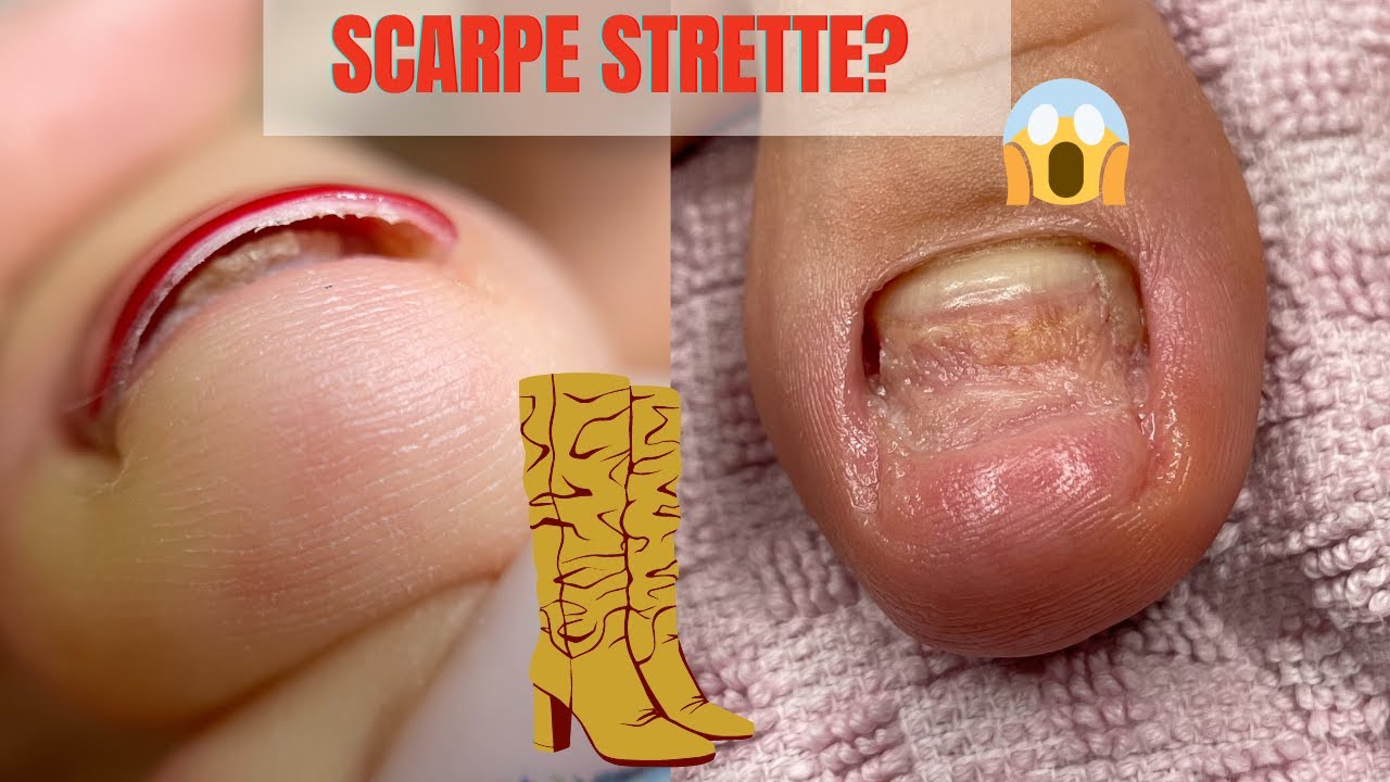 🦶🤕ONICOLISI PEDICUR/ 👢Conseguenze delle scarpe strette