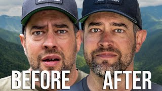 What it’s like to have eye bags removed