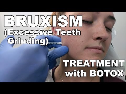 Teeth Grinding (Bruxism) Treatment with Botox - Dr. Paul Ruff | West End Plastic Surgery