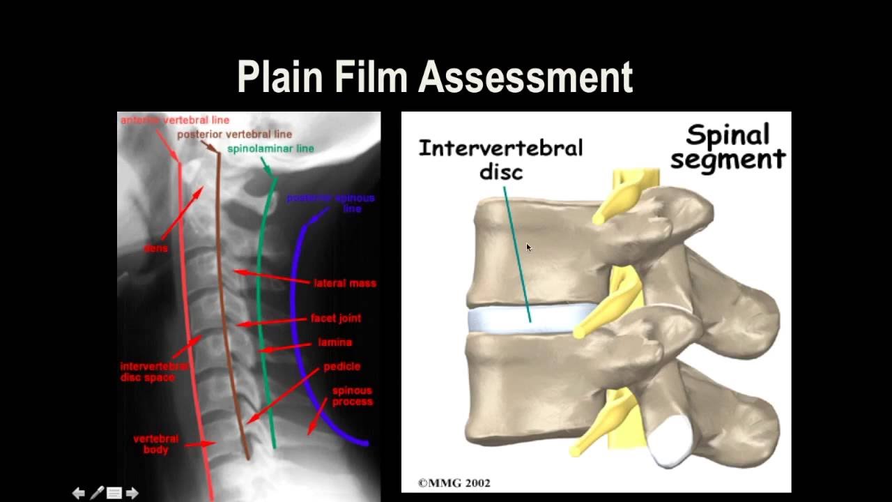 Cervical Spine X-Ray