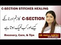 C Section Delivery Internal Stitches Wound Healing Care Recovery Tips Tanky Kesy Theek Kren Gy