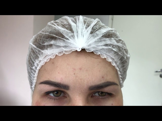 Коррекция морщин ботоксом