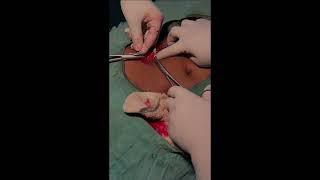 Appendectomy Surgery | Step-by-Step Surgical Procedure | Medical Educational Video