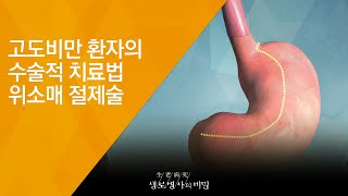 [명의 의학백과📖] 위 소매 절제술