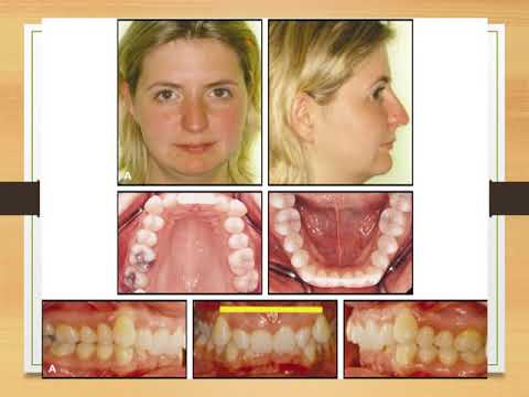 Angle’s classification of malocclusion - Orthodontics