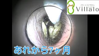 耳掃除動画vol.80「あれから7ヶ月」