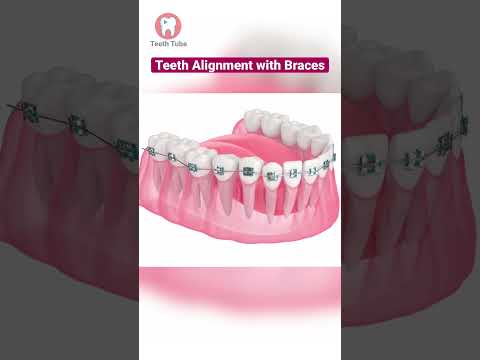Teeth Alignment with Braces (3D Animation) #shorts