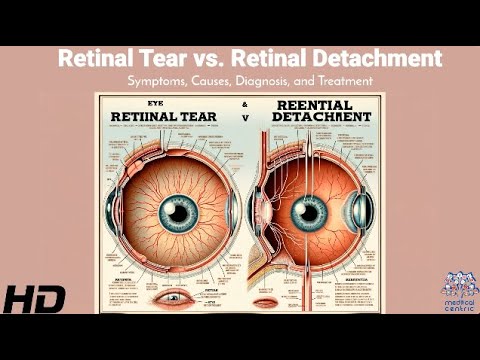 Retinal Tear vs. Retinal Detachment: Know the Difference and Save Your Vision!