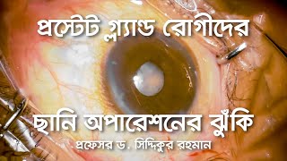 প্রস্টেট গ্ল্যান্ড রোগীদের ছানি অপারেশনের ঝুঁকি: Challenges of Phaco surgery in Floppy Iris