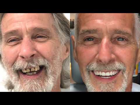 All-on-6 Full Mouth Rehab