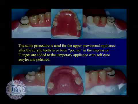 Rotational Path Partial Dentures