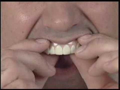 Imako Cosmetic Teeth® Fitting Instructions