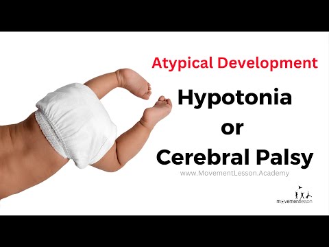 Atypical Development Baby Hypotonia or Cerebral Palsy - How do I tell at 10 Months Old?