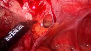 preview picture of video 'Laparoscopic adhesiolysis for acute small bowel obstruction'