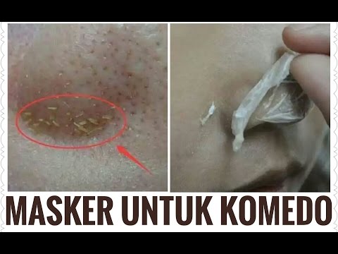 download Cara Alami Menghilangkan Komedo Dan Mengencangkan Kulit Wajah, download video viral Cara Alami Menghilangkan Komedo Dan Mengencangkan Kulit Wajah gratis, unduh video klip Cara Alami Menghilangkan Komedo Dan Mengencangkan Kulit Wajah