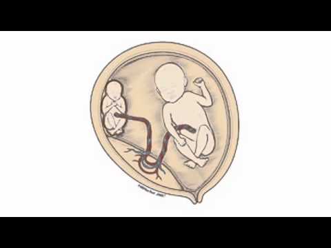 What is twin-to-twin transfusion syndrome (TTTS)?