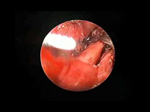 Thoracoscopic Repair of Type C Esophageal Atresia