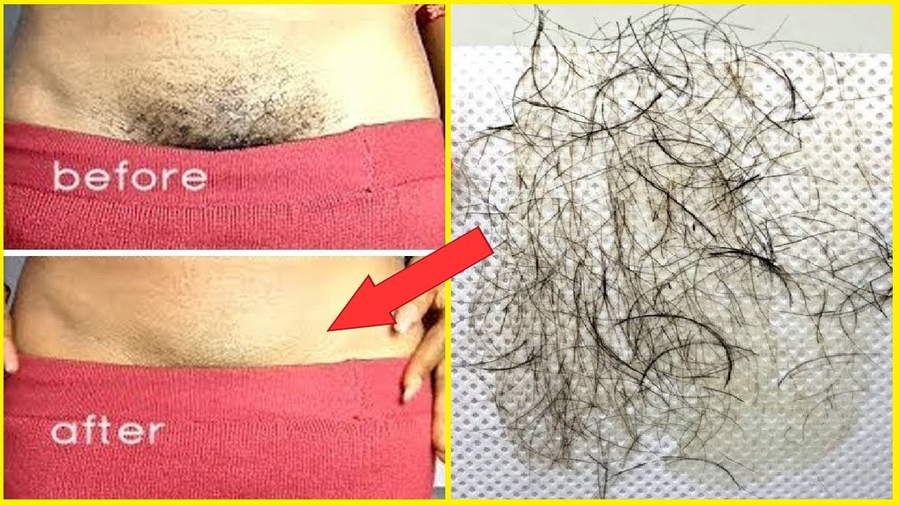 In Just 5 Minutes Remove Pubic Hair Permanently No Shave No Wax