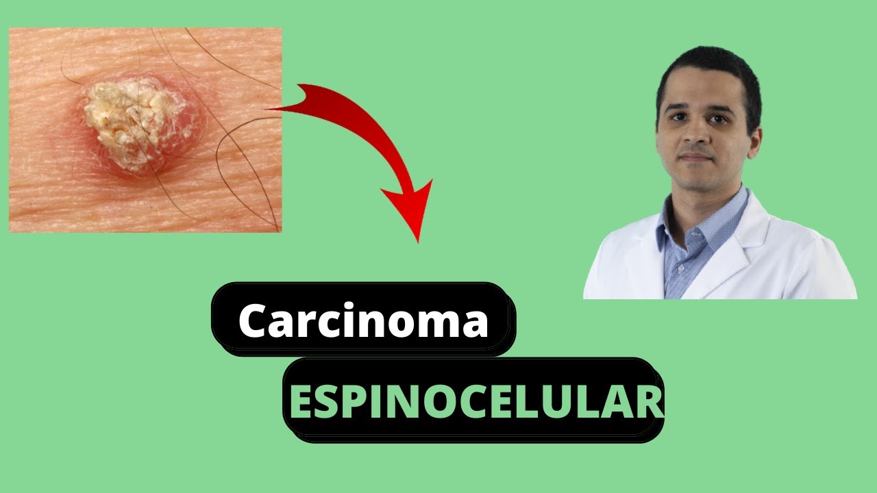 Carcinoma espinocelular - Segundo tipo mais comum de câncer de pele.
