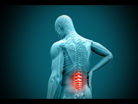 Namen Drogen für degenerative Bandscheibenerkrankungen Schmerz unterhalb der Taille nach dem Schlafen