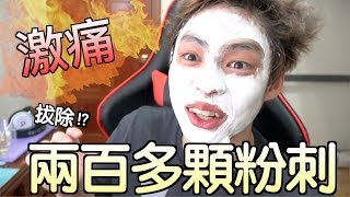 趣味生活-超級痛，算出臉上有兩百多顆粉刺