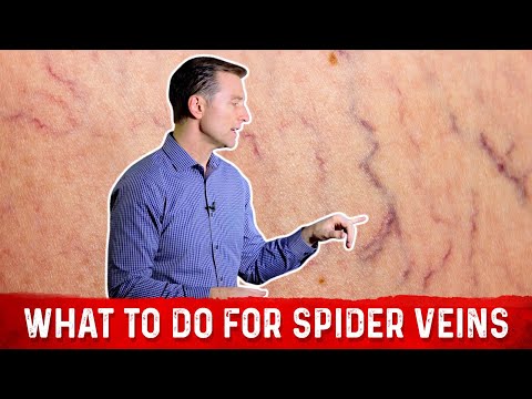 Best Treatment For Spider Veins & Chronic Venous Insufficiency – Dr. Berg
