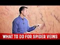 Best Treatment For Spider Veins & Chronic Venous Insufficiency – Dr. Berg