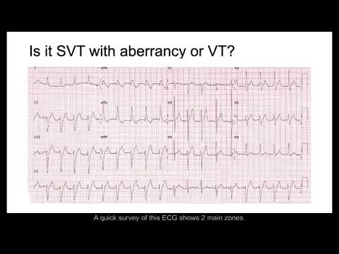 SVT with Aberrancy or VT?