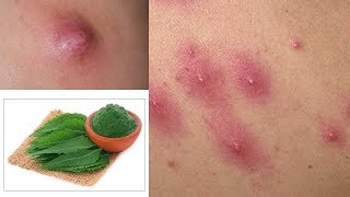 Remedies for inner thighs pimples | Health and life