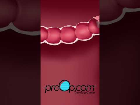 PreOp® Colonoscopy Lower Endoscopy*